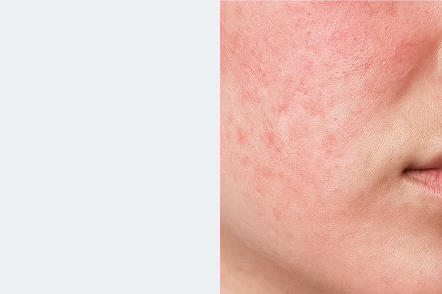 Eczema PLP