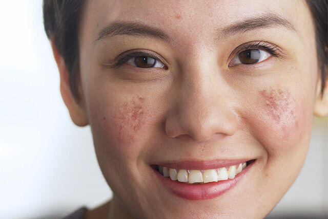 Acne-Prone Skin