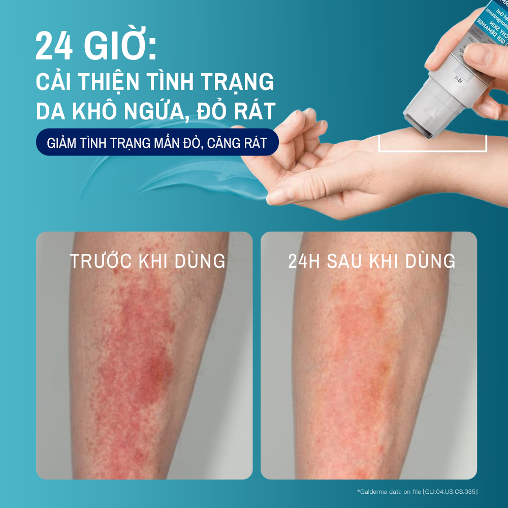 Gel L&agrave;m Dịu V&agrave; Hỗ Trợ Giảm Ngứa Cho Da Ch&agrave;m, Vi&ecirc;m Da Cơ Địa Cetaphil Pro AD Derma Instant Relief & Moisturising Gel7
